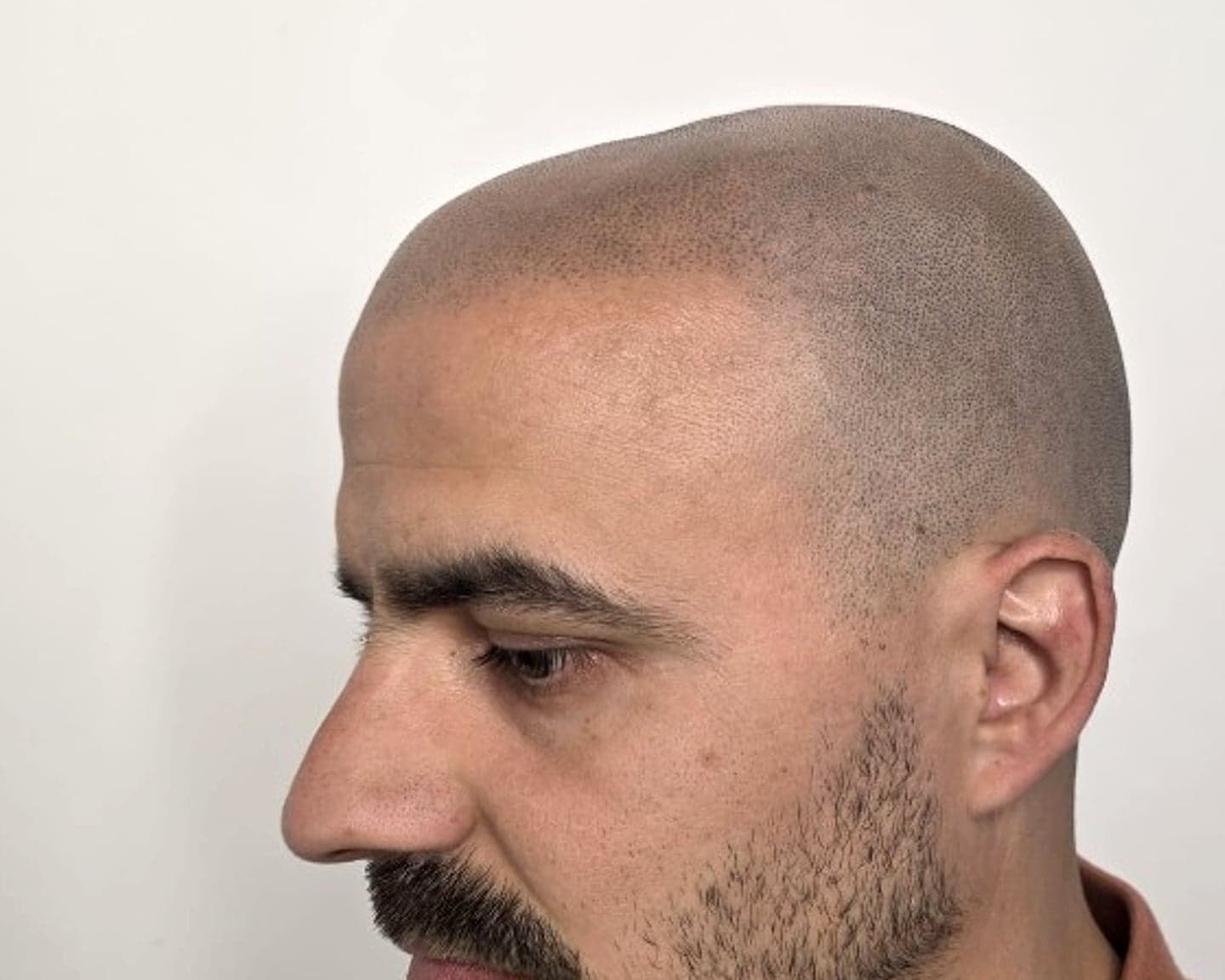 Après 4 séances de tricopigmentation — effet crâne rasé homogène