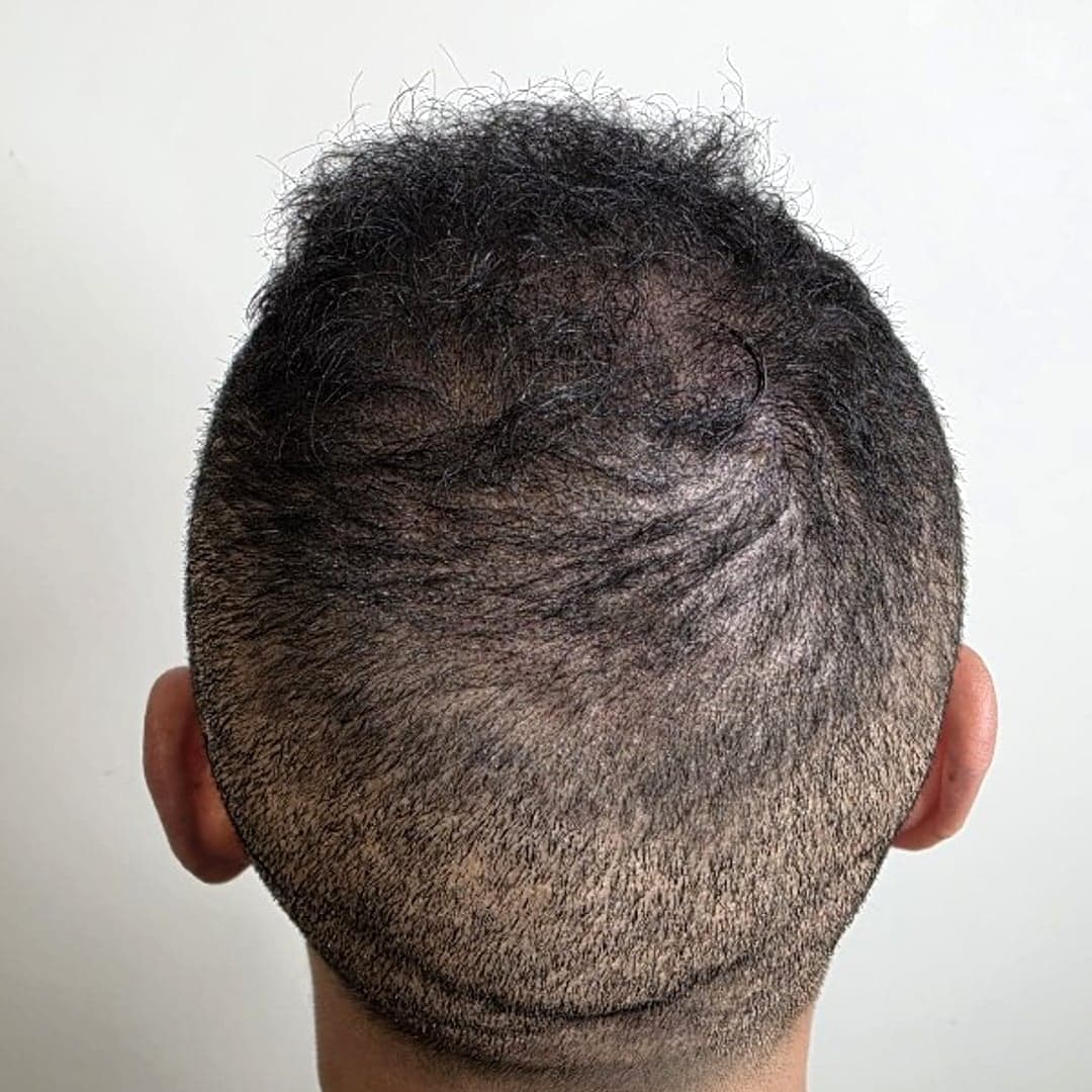 Après densification capillaire — nuque et fade, vue anonyme