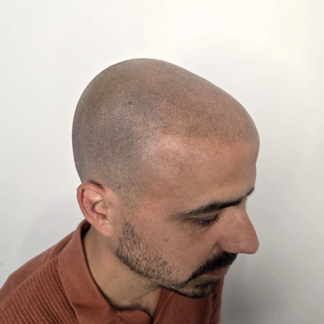 Après 4 séances — tricopigmentation, vue trois-quarts