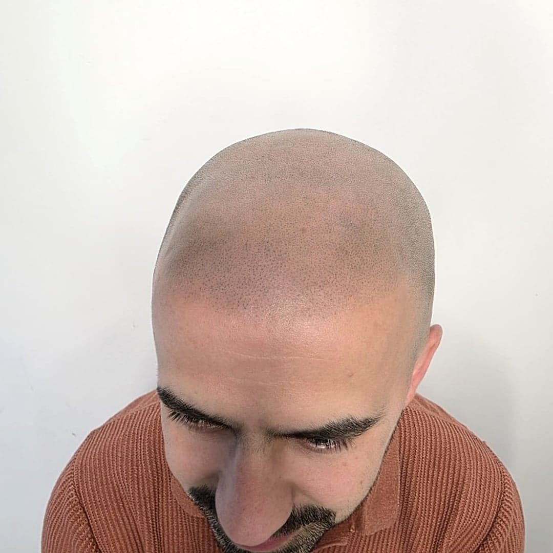 Après 4 séances — tricopigmentation, vue du vertex