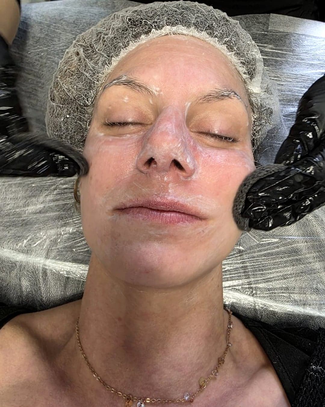 Application de crème hydratante en fin de séance microneedling